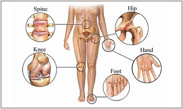 Arthritis