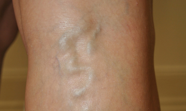 Varicose Veins