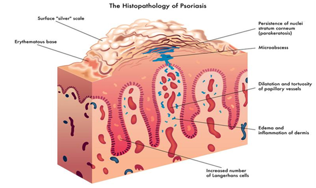 Psoriasis